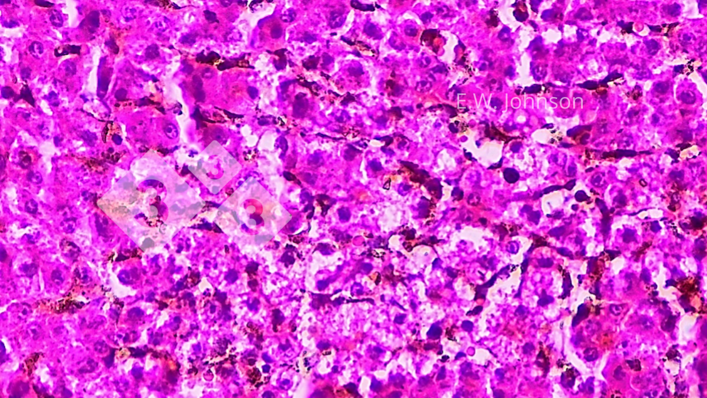 <p>Imagen 4. Necrosis hep&aacute;tica focal con cuerpos de inclusi&oacute;n&nbsp;intranucleares anfof&iacute;licos ocasionales en la zona perinecr&oacute;tica. H&iacute;gado.</p>
